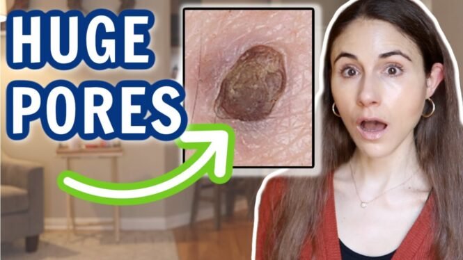 HUGE PORES ON THE FACE & HOW TO GET RID OF THEM // Dermatologist @DrDrayzday