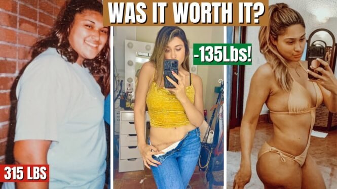 WHAT THEY DON’T TELL YOU ABOUT WEIGHT LOSS & SURGERY! How I lost 135 Lbs on the Keto Diet